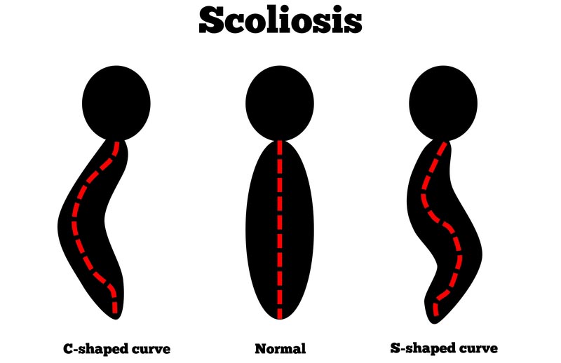 Norman, Oklahoma scoliosis treatment
